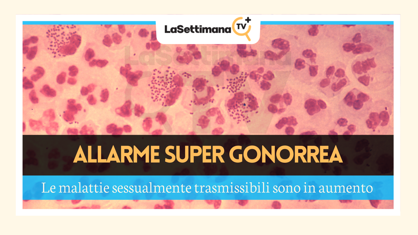super gonorrea